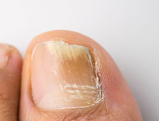 ultralase fungal toe saltney