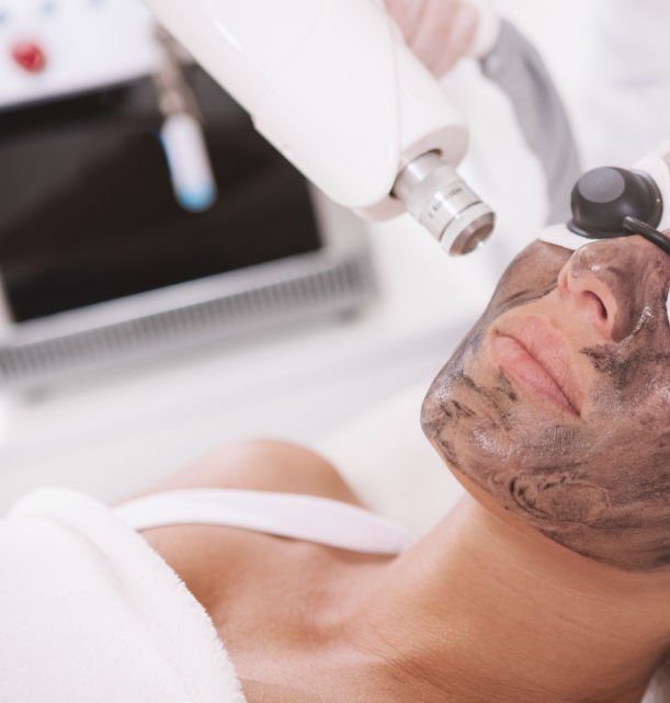 ultralase carbon facial saltney chester