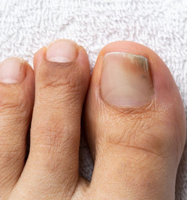ultralase saltney chester fungal nail