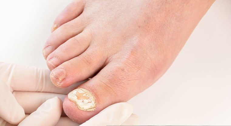 ultralase saltney chester fungal nai