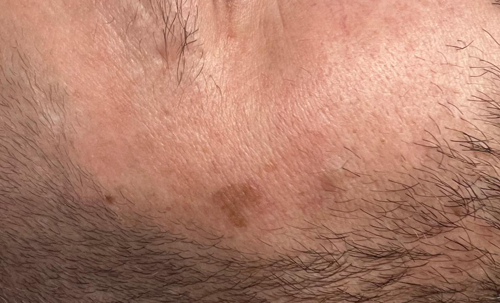 sun-blemish-age-spot-removal-laser-treatment-saltney-chester