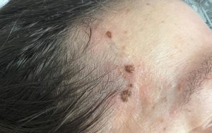 mole-removal-laser-treatment-saltney-chester