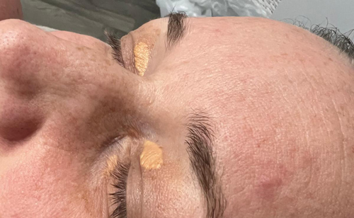 xanthasma-cholestrol-skin-desposits-laser-treatment-removal-saltney-chester