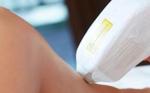 laser-hair-removal-saltney-chester