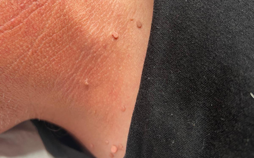 laser-skin-tag-removal-saltney-chester