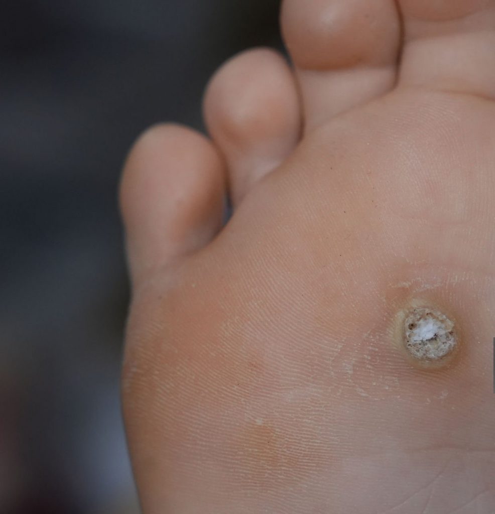 verruca-laser-treatment-removal-saltney-chester